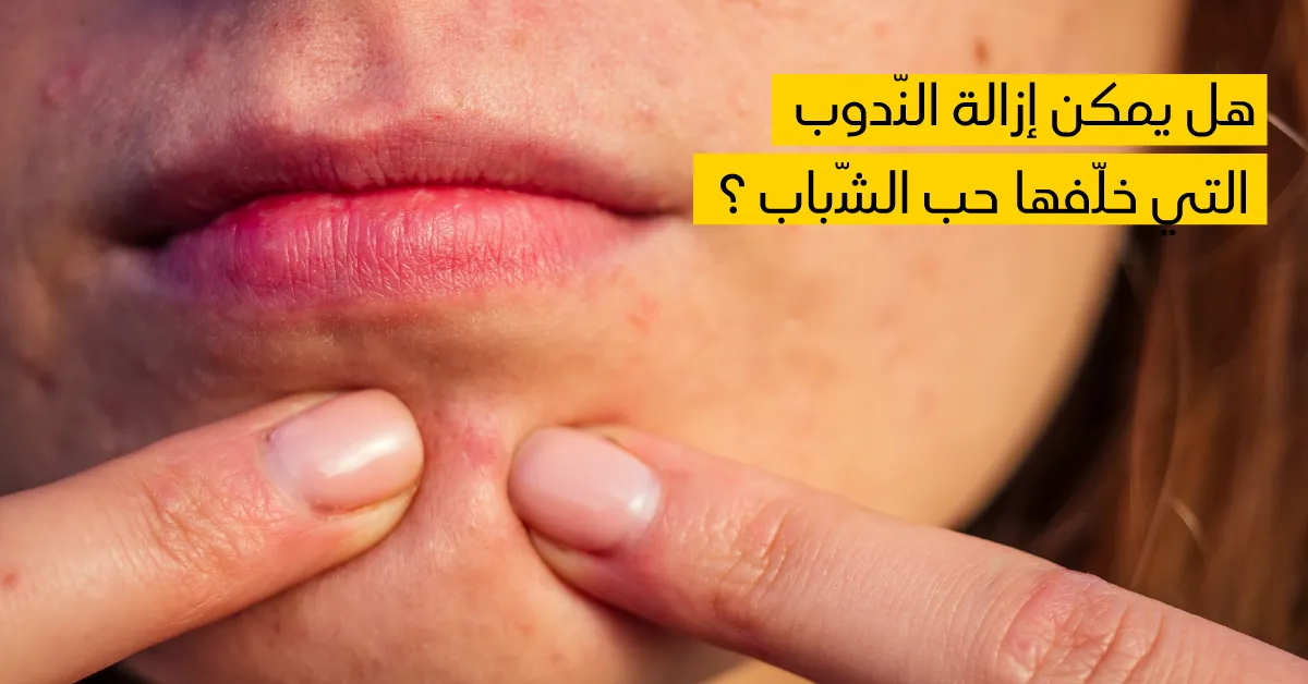 هل يمكن إزالة النّدوب التي خلّفها حب الشّباب ؟